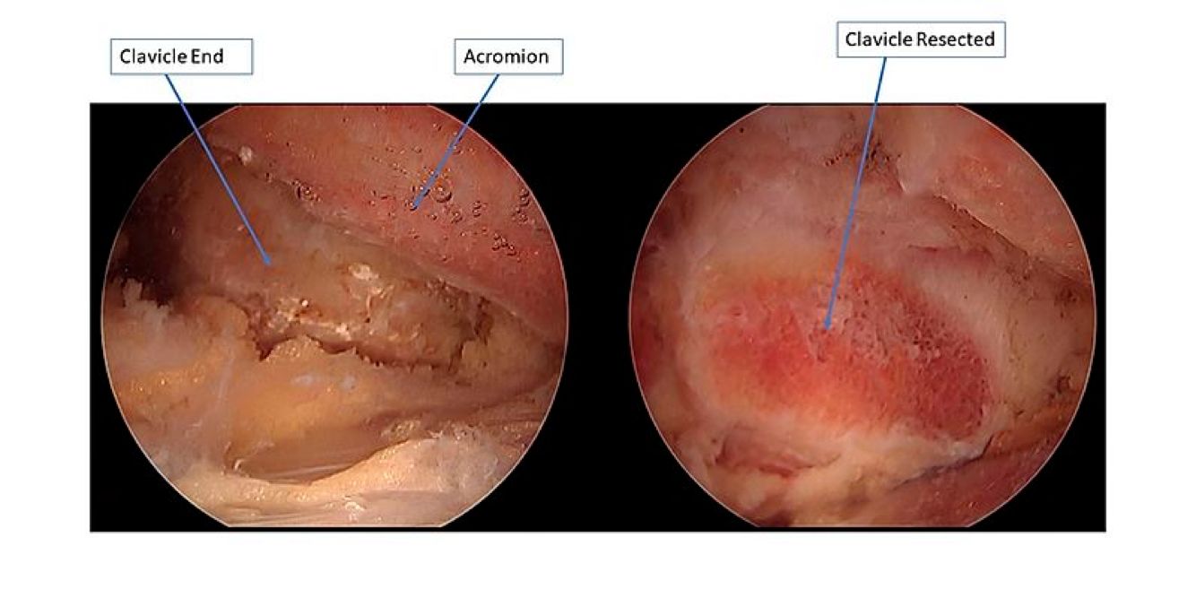 arthroscopic-images-before-and-after-distal-clavicle-resection.jpg