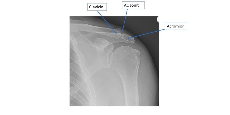 shoulder-radiographs-demonstrating-AC-arthritis.jpg