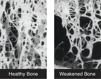 Healthy bone vs weakened bone x ray