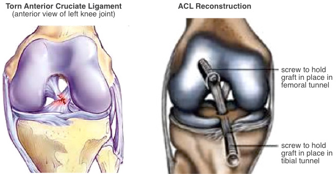 ACL Injury  ACL Reconstruction - Spine & Orthopedic Center
