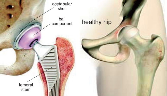 total-hip-replacement