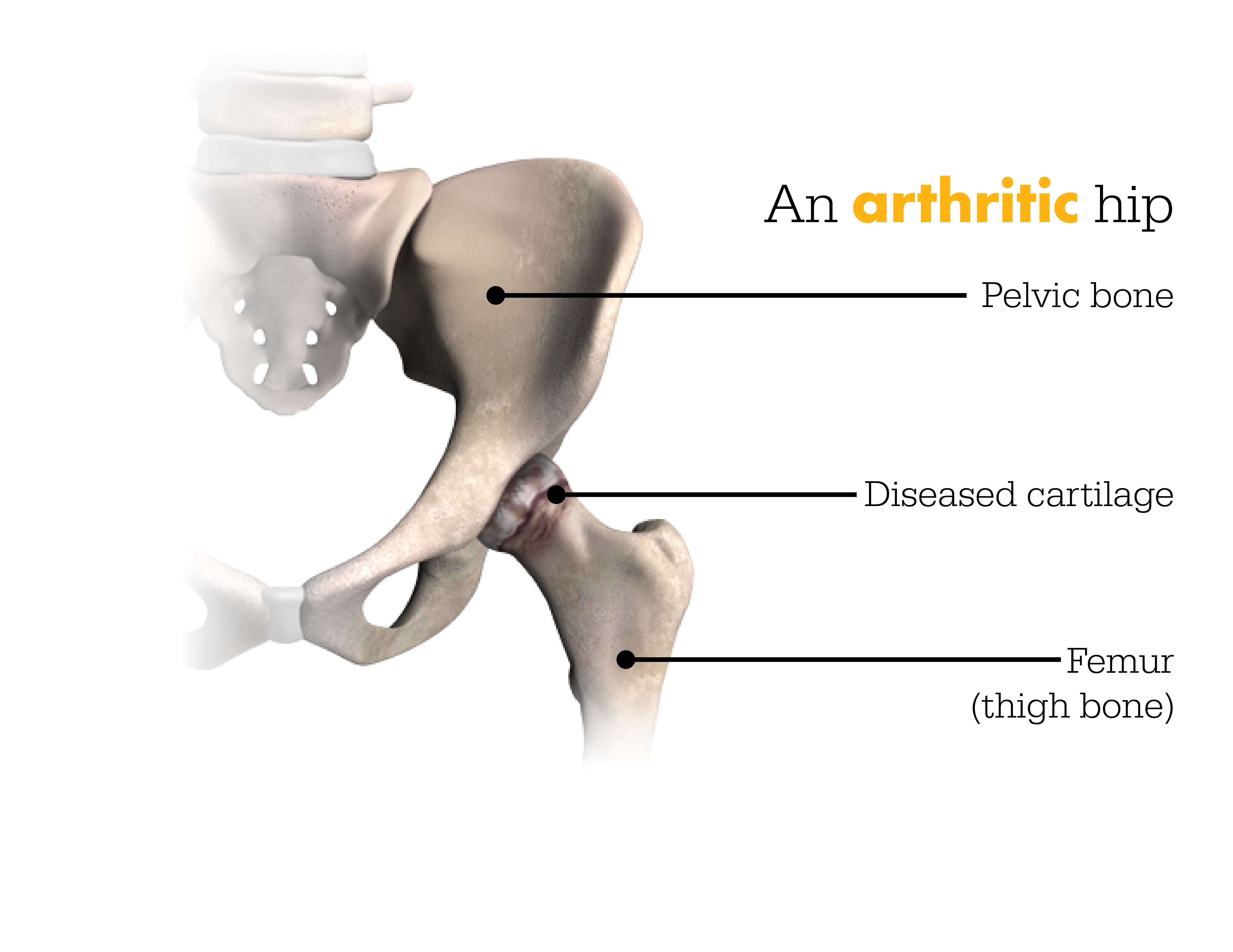 arthritic-hip