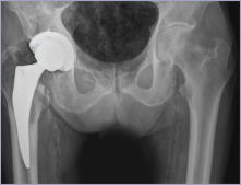 Post surgery hip x ray