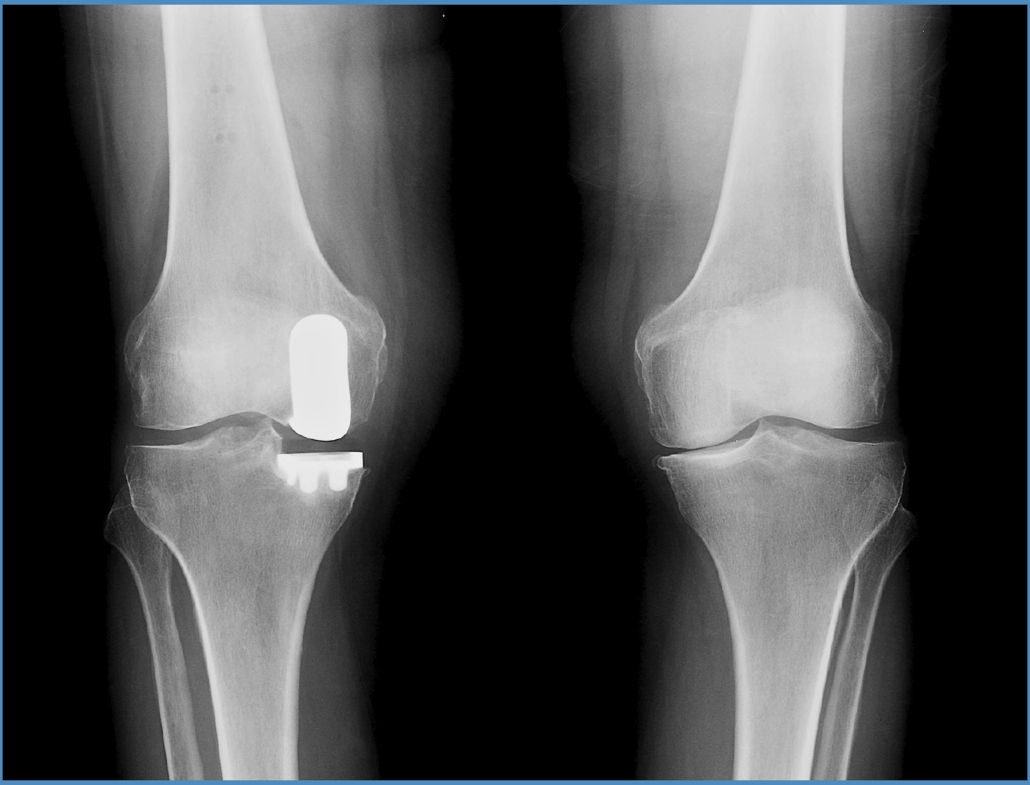 X ray of partial knee replacement
