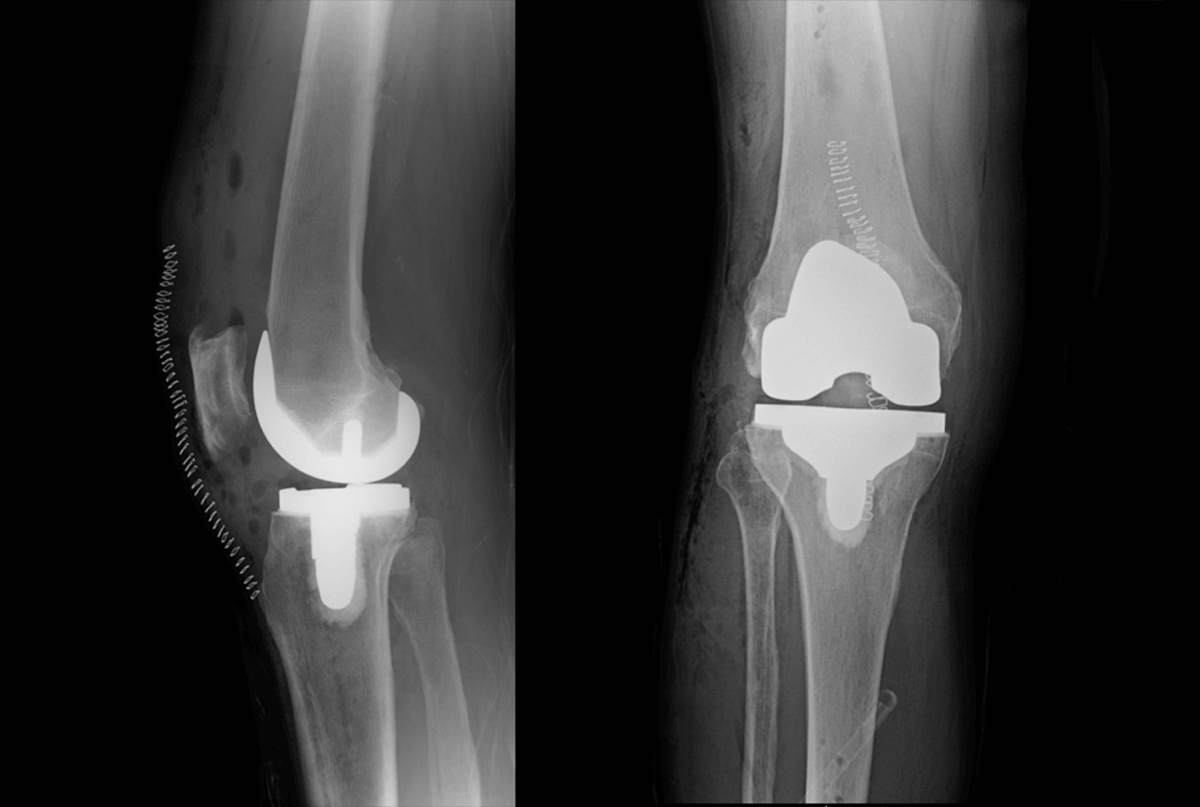 X ray of total knee replacement
